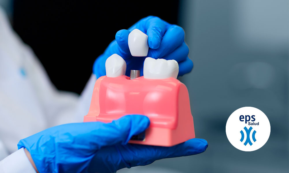 Implantes dentales: ¿Qué es un implante dental?